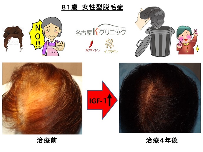 円形脱毛症　病院